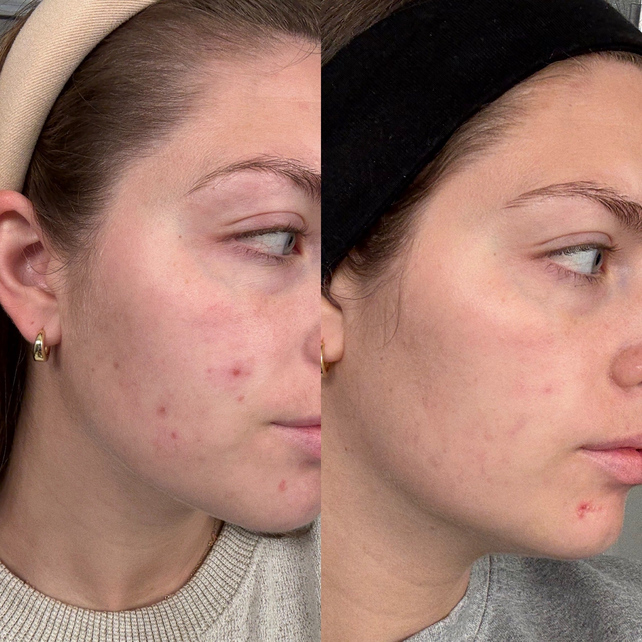 Normal to Dry Skin Starter Kit