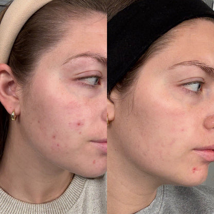 Normal to Dry Skin Starter Kit