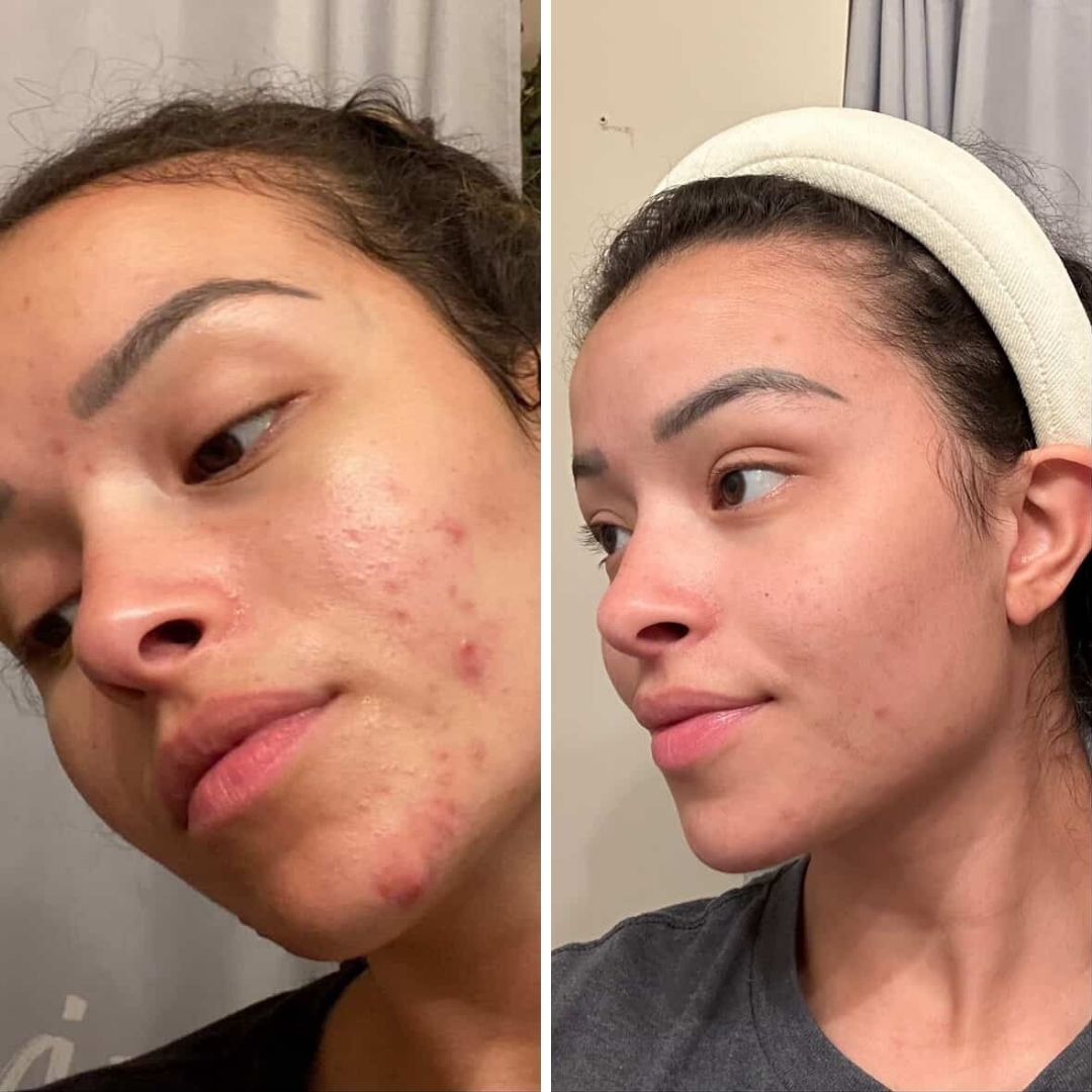Oily and Acne Starter Kit