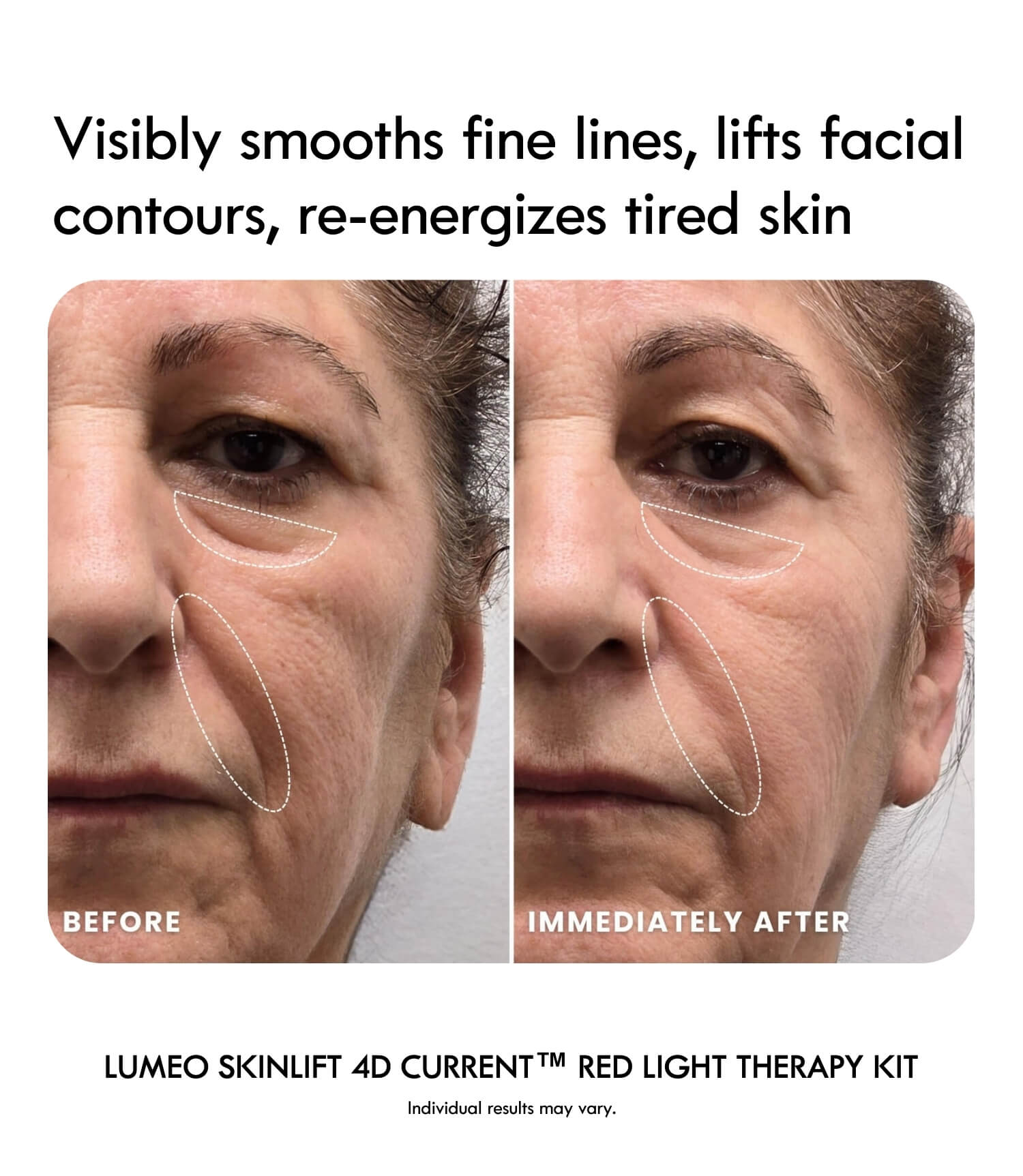 Lumeo SkinLift 4D Current™ Red Light Therapy Kit