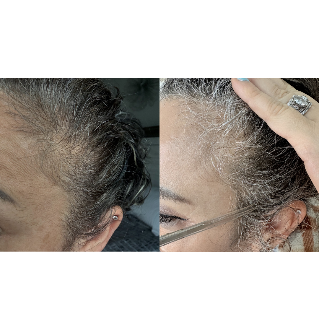 Hair Renewal Bundle for Hair Growth & Scalp Support