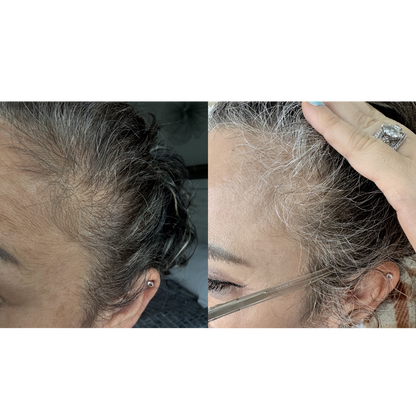 Hair Renewal Bundle for Hair Growth & Scalp Support