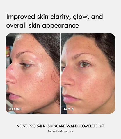 Velve Pro 5-in-1 Skincare Wand Complete Kit